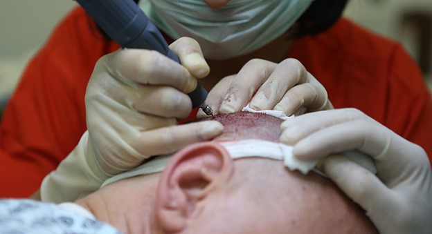 دوره آموزش کاشت مو